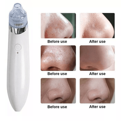 Electric Facial Skin Care Pore Blackhead Cleaner Remover Vacuum Professional Acne Cleanser  Comedon 4